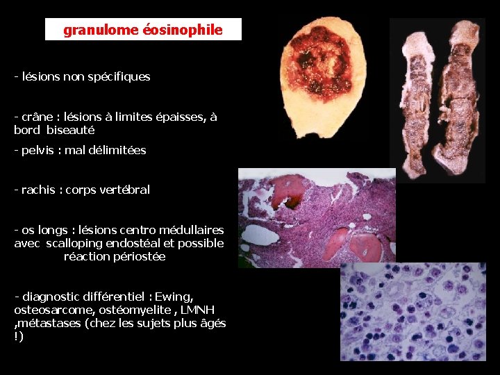 granulome éosinophile - lésions non spécifiques - crâne : lésions à limites épaisses, à