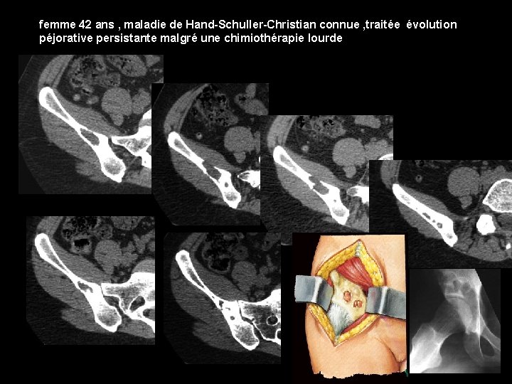 femme 42 ans , maladie de Hand-Schuller-Christian connue , traitée évolution péjorative persistante malgré