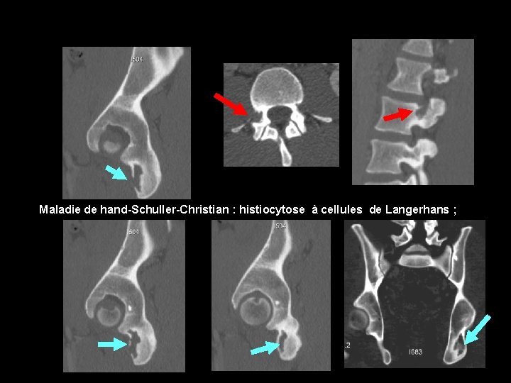 Maladie de hand-Schuller-Christian : histiocytose à cellules de Langerhans ; 