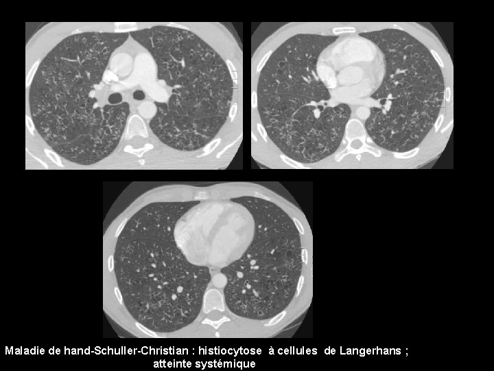 Maladie de hand-Schuller-Christian : histiocytose à cellules de Langerhans ; atteinte systémique 