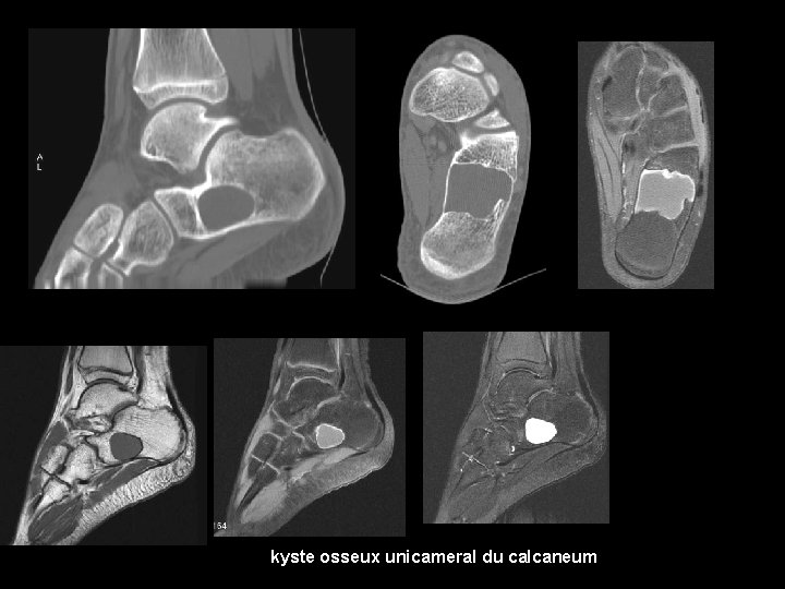 kyste osseux unicameral du calcaneum 