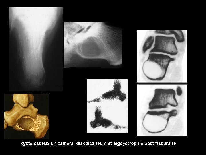 kyste osseux unicameral du calcaneum et algdystrophie post fissuraire 