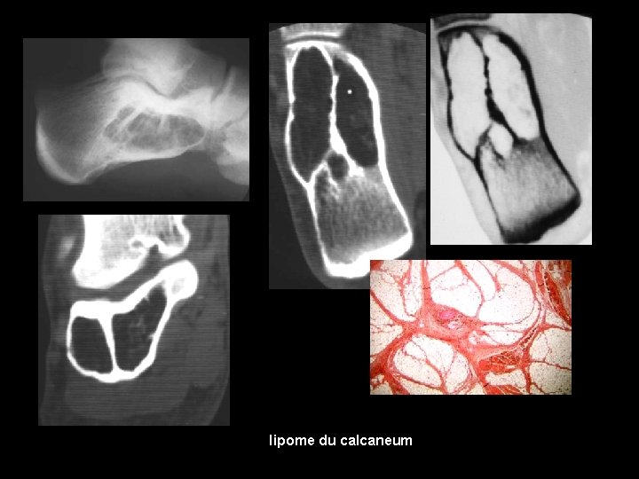 lipome du calcaneum 