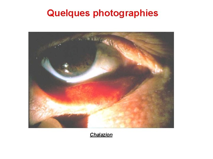 Quelques photographies Chalazion 