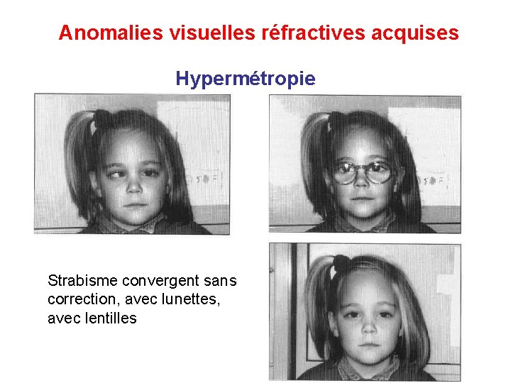 Anomalies visuelles réfractives acquises Hypermétropie Strabisme convergent sans correction, avec lunettes, avec lentilles 