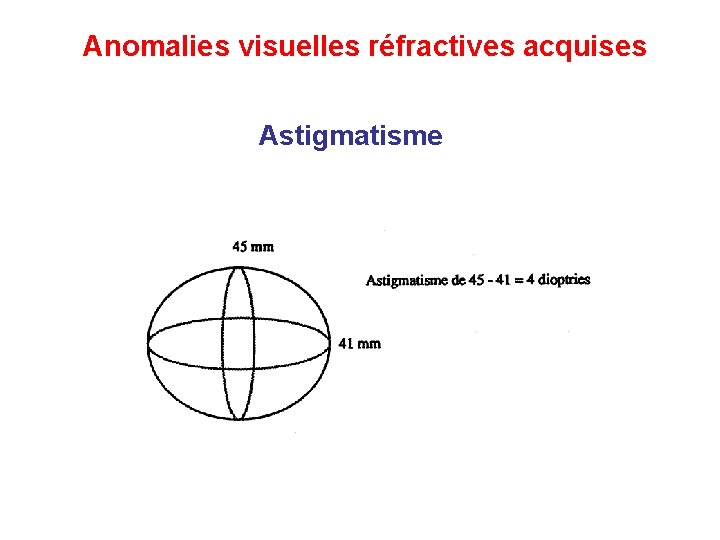 Anomalies visuelles réfractives acquises Astigmatisme 