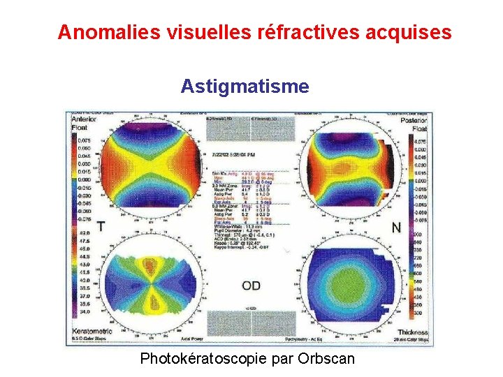 Anomalies visuelles réfractives acquises Astigmatisme Photokératoscopie par Orbscan Anomalies visuelles réfractives acquises Astigmatisme Photokératoscopie par Orbscan