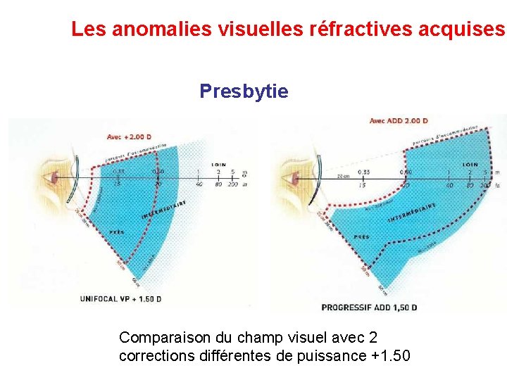 Les anomalies visuelles réfractives acquises Presbytie Comparaison du champ visuel avec 2 corrections différentes