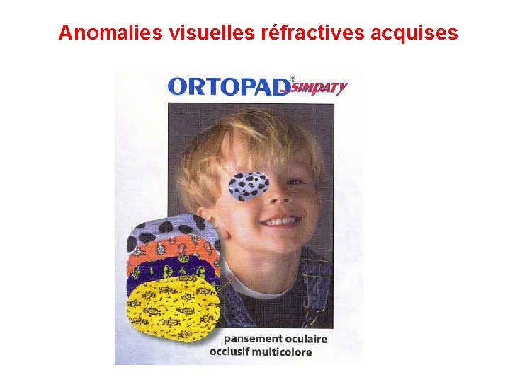 Anomalies visuelles réfractives acquises 