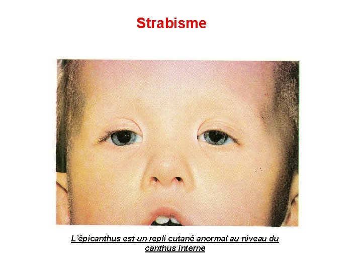 Strabisme L’épicanthus est un repli cutané anormal au niveau du canthus interne 