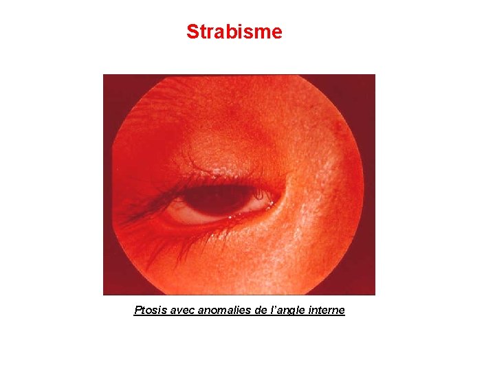 Strabisme Ptosis avec anomalies de l’angle interne 