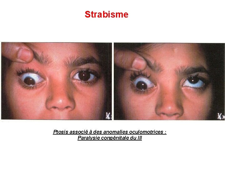 Strabisme Ptosis associé à des anomalies oculomotrices : Paralysie congénitale du III 