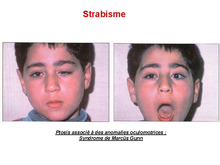 Strabisme Ptosis associé à des anomalies oculomotrices : Syndrome de Marcüs Gunn 