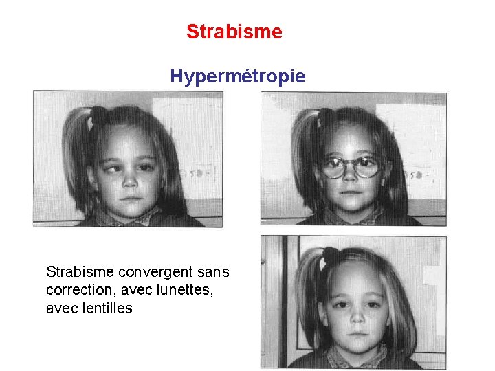 Strabisme Hypermétropie Strabisme convergent sans correction, avec lunettes, avec lentilles 