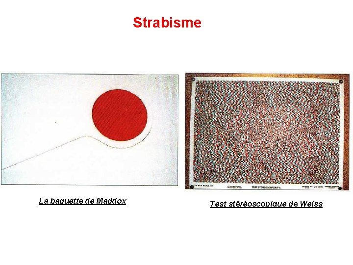 Strabisme La baguette de Maddox Test stéréoscopique de Weiss Strabisme La baguette de Maddox Test stéréoscopique de Weiss