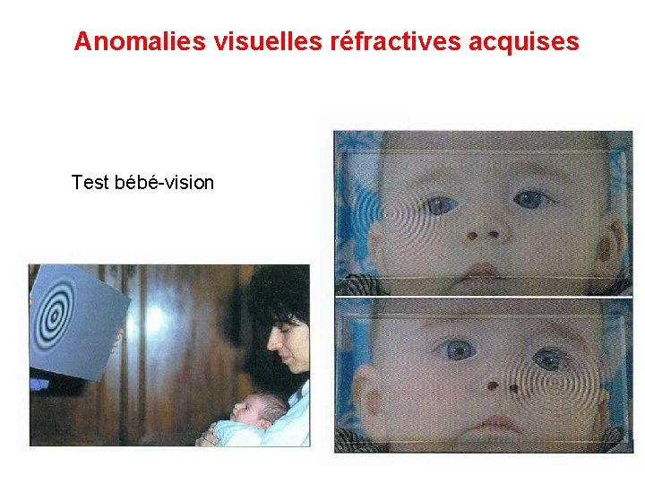 Anomalies visuelles réfractives acquises Test bébé-vision 