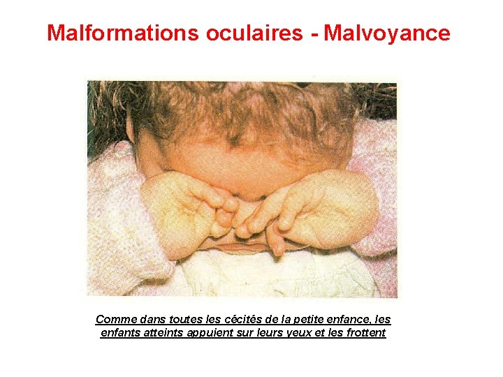 Malformations oculaires - Malvoyance Comme dans toutes les cécités de la petite enfance, les