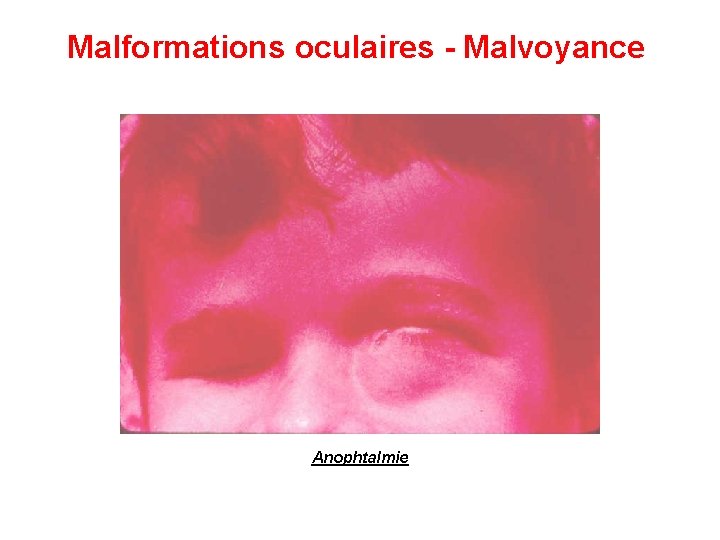 Malformations oculaires - Malvoyance Anophtalmie 