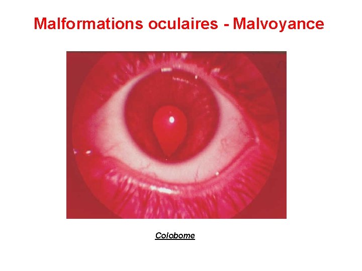 Malformations oculaires - Malvoyance Colobome 