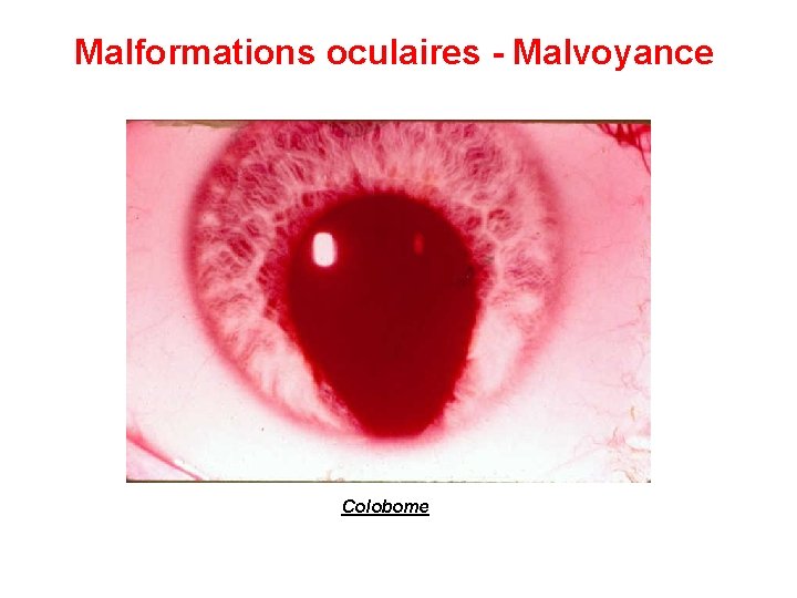 Malformations oculaires - Malvoyance Colobome 