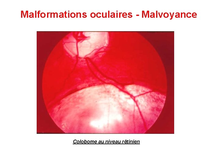 Malformations oculaires - Malvoyance Colobome au niveau rétinien Malformations oculaires - Malvoyance Colobome au niveau rétinien