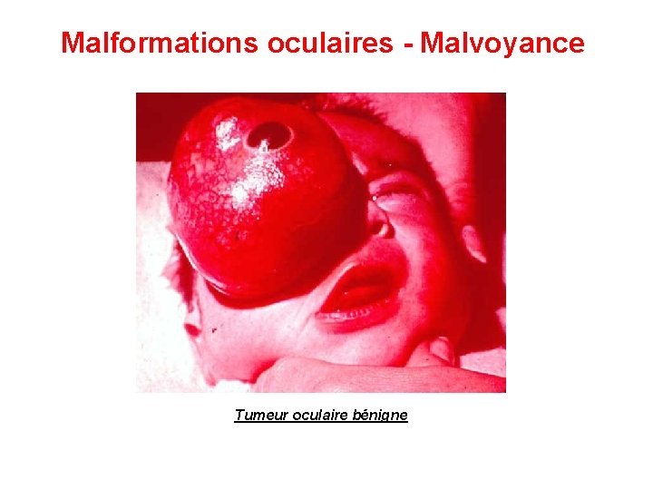 Malformations oculaires - Malvoyance Tumeur oculaire bénigne 