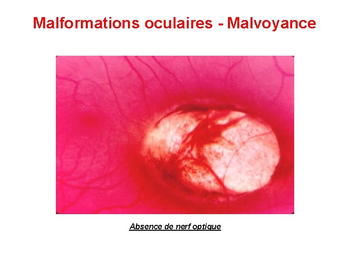 Malformations oculaires - Malvoyance Absence de nerf optique 