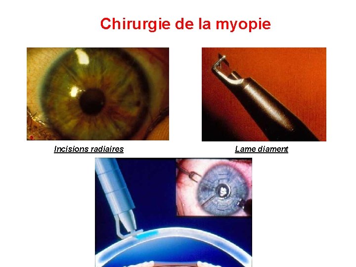 Chirurgie de la myopie Incisions radiaires Lame diament 