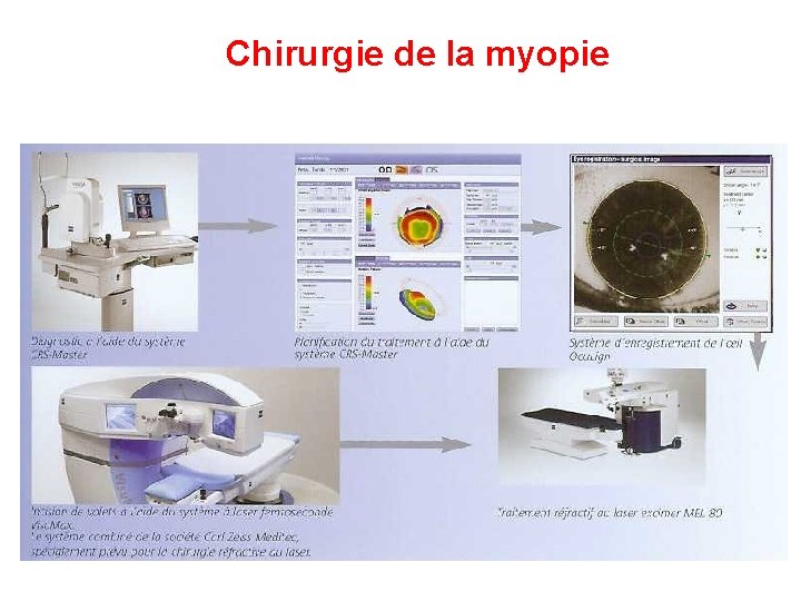 Chirurgie de la myopie 