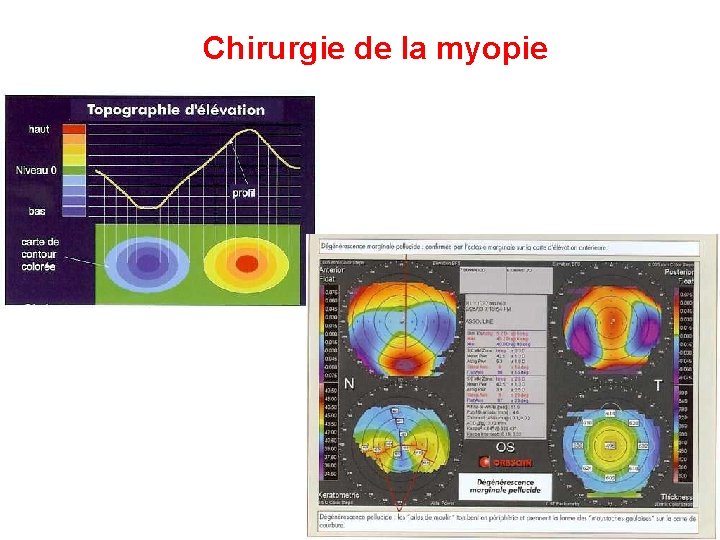 Chirurgie de la myopie Chirurgie de la myopie