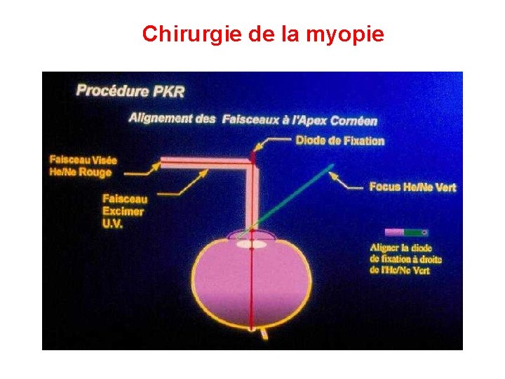 Chirurgie de la myopie 