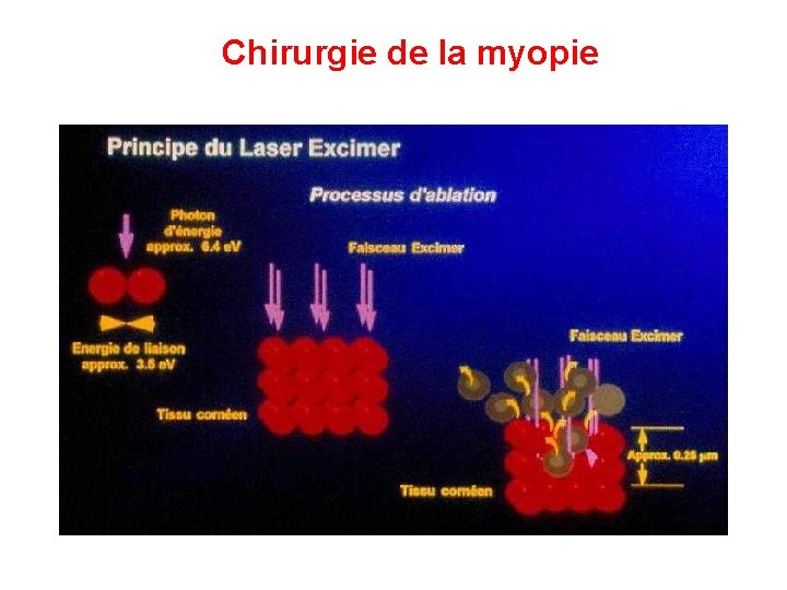 Chirurgie de la myopie 