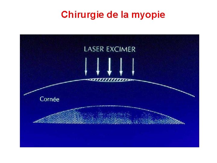 Chirurgie de la myopie 