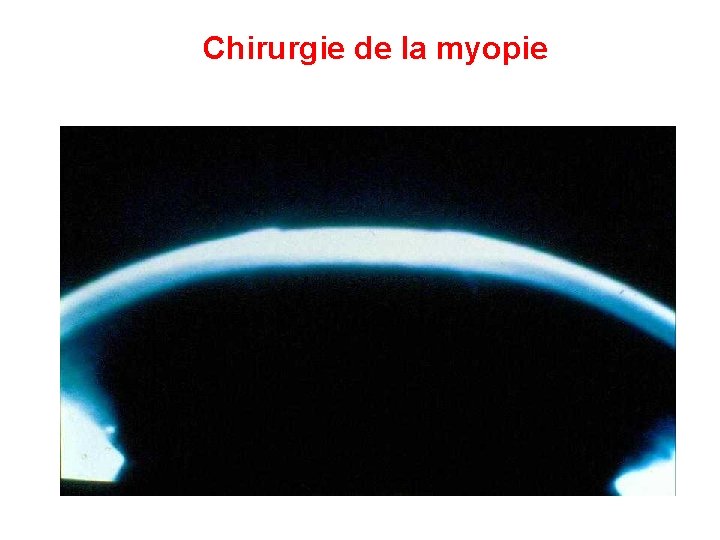 Chirurgie de la myopie 