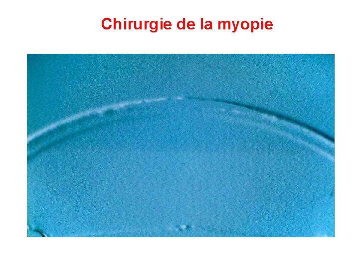 Chirurgie de la myopie 