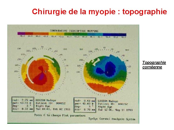 Chirurgie de la myopie : topographie Topographie cornéenne 