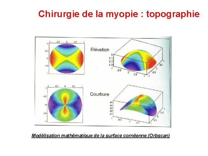 Chirurgie de la myopie : topographie Modélisation mathématique de la surface cornéenne (Orbscan) 