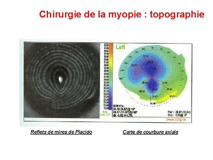 Chirurgie de la myopie : topographie Reflets de mires de Placido Carte de courbure