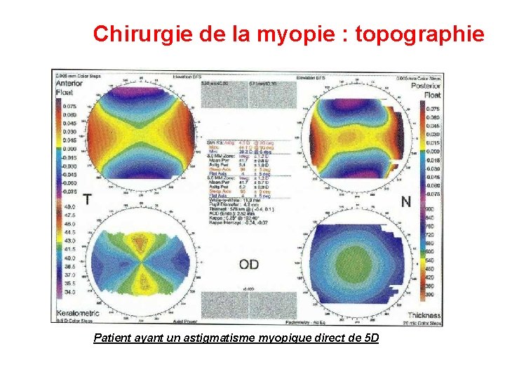 Chirurgie de la myopie : topographie Patient ayant un astigmatisme myopique direct de 5 Chirurgie de la myopie : topographie Patient ayant un astigmatisme myopique direct de 5