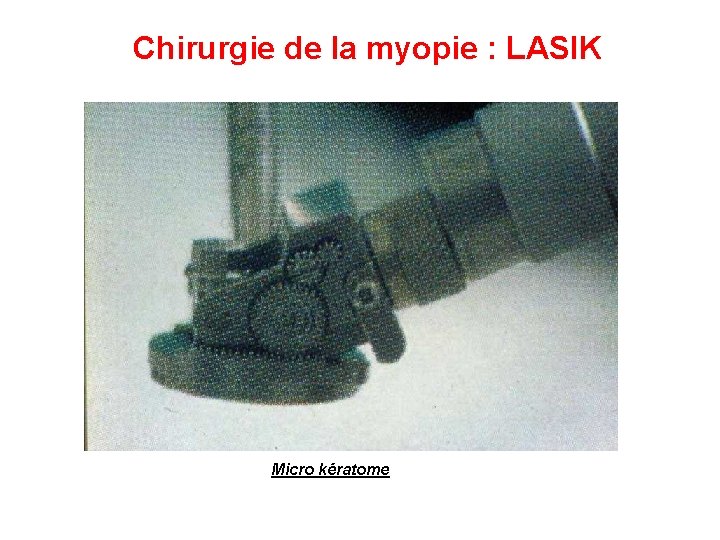Chirurgie de la myopie : LASIK Micro kératome Chirurgie de la myopie : LASIK Micro kératome
