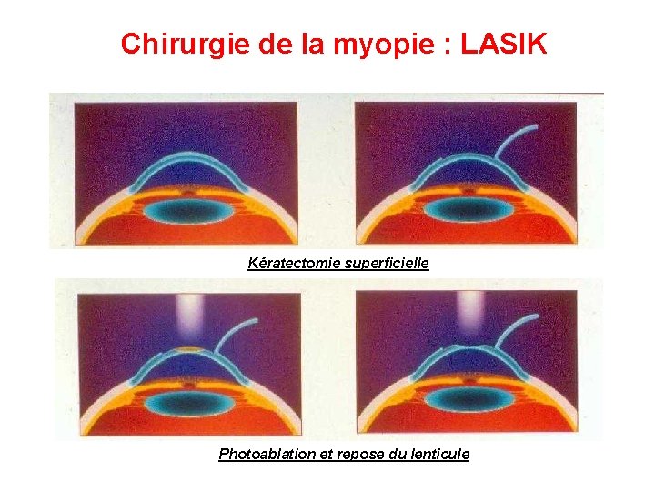 Chirurgie de la myopie : LASIK Kératectomie superficielle Photoablation et repose du lenticule 