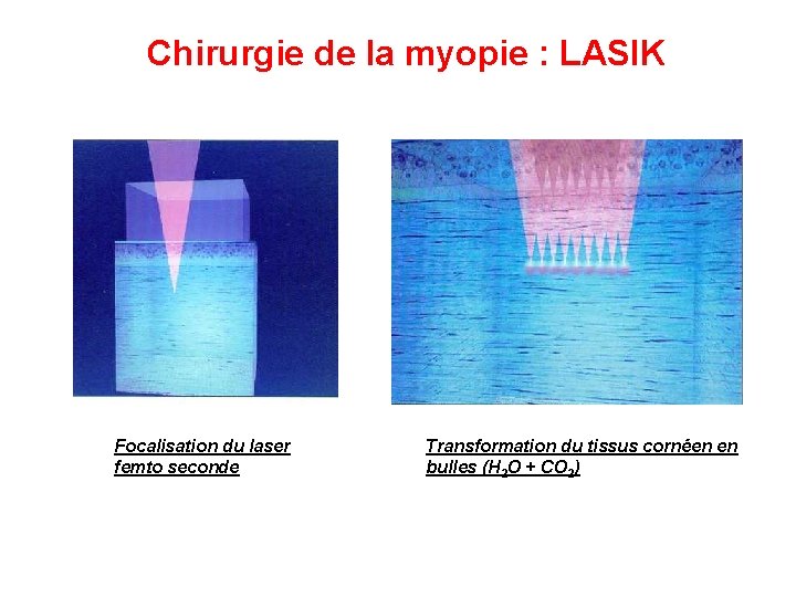 Chirurgie de la myopie : LASIK Focalisation du laser femto seconde Transformation du tissus