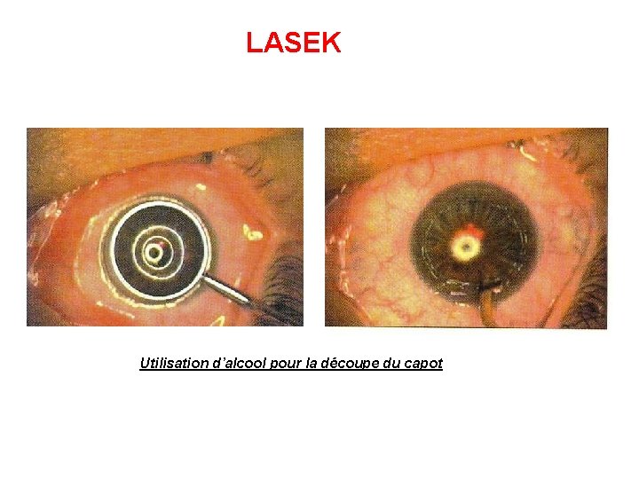 LASEK Utilisation d’alcool pour la découpe du capot 