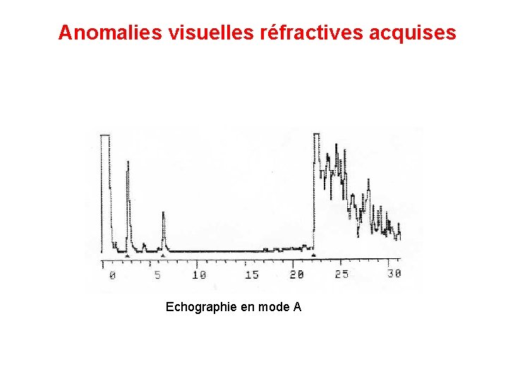 Anomalies visuelles réfractives acquises Echographie en mode A 