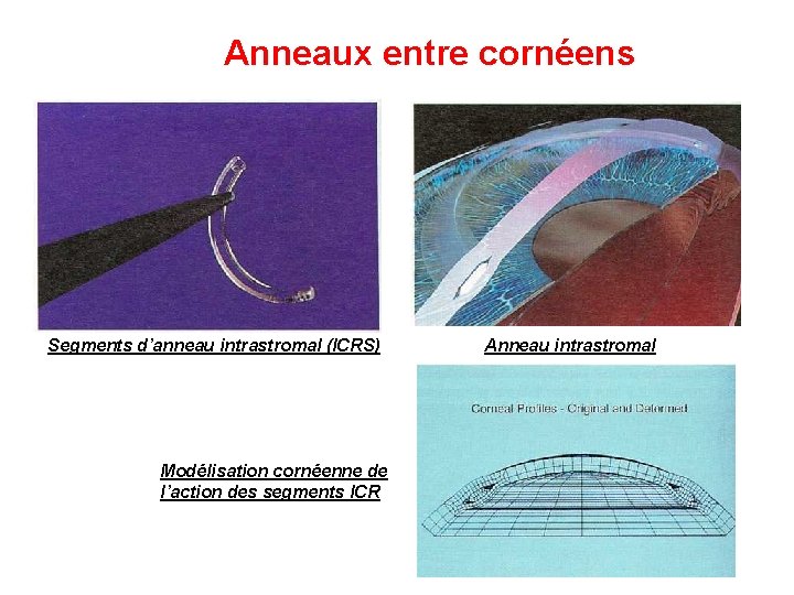 Anneaux entre cornéens Segments d’anneau intrastromal (ICRS) Modélisation cornéenne de l’action des segments ICR Anneaux entre cornéens Segments d’anneau intrastromal (ICRS) Modélisation cornéenne de l’action des segments ICR