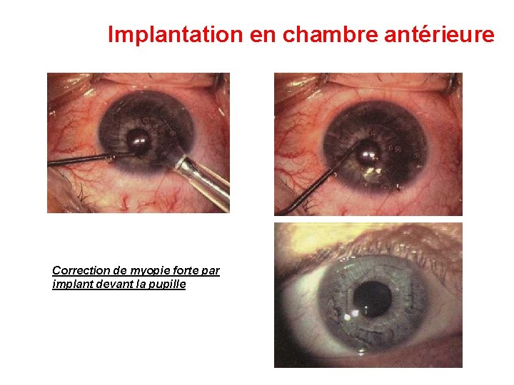 Implantation en chambre antérieure Correction de myopie forte par implant devant la pupille 