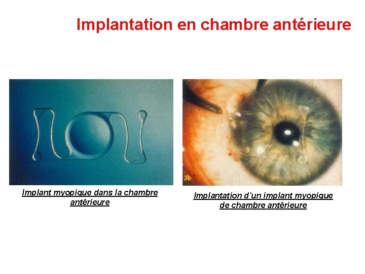 Implantation en chambre antérieure Implant myopique dans la chambre antérieure Implantation d’un implant myopique