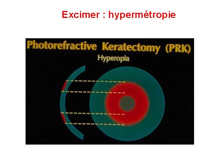 Excimer : hypermétropie Excimer : hypermétropie