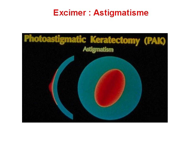 Excimer : Astigmatisme 