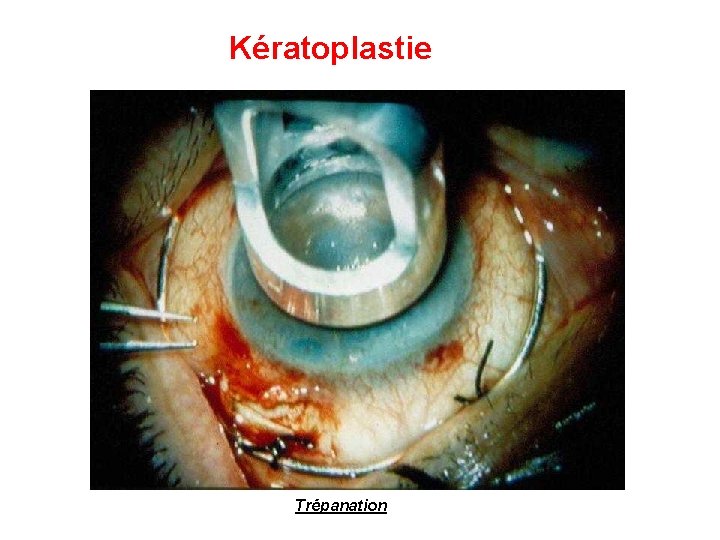 Kératoplastie Trépanation 